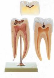 臼歯虫歯模型